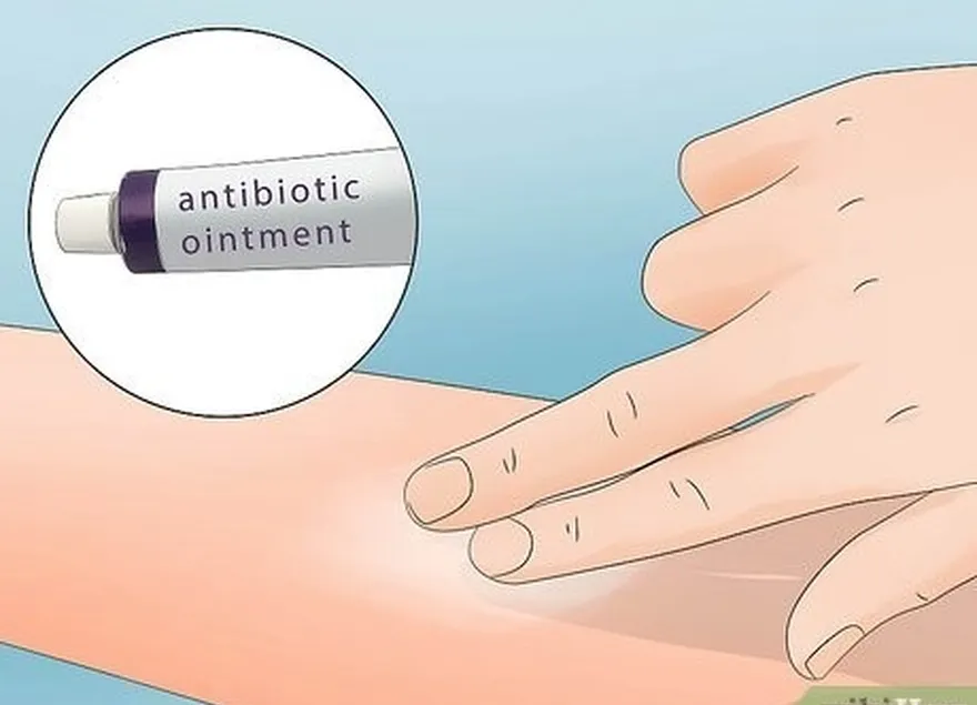 addım 3 antibiotik məlhəm tətbiq edin.