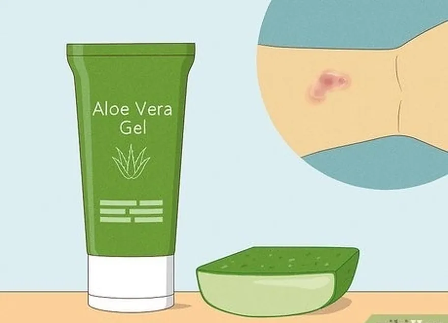 addım 7 qaşıntıya kömək etmək üçün səpgilərinizə aloe vera tətbiq edin.