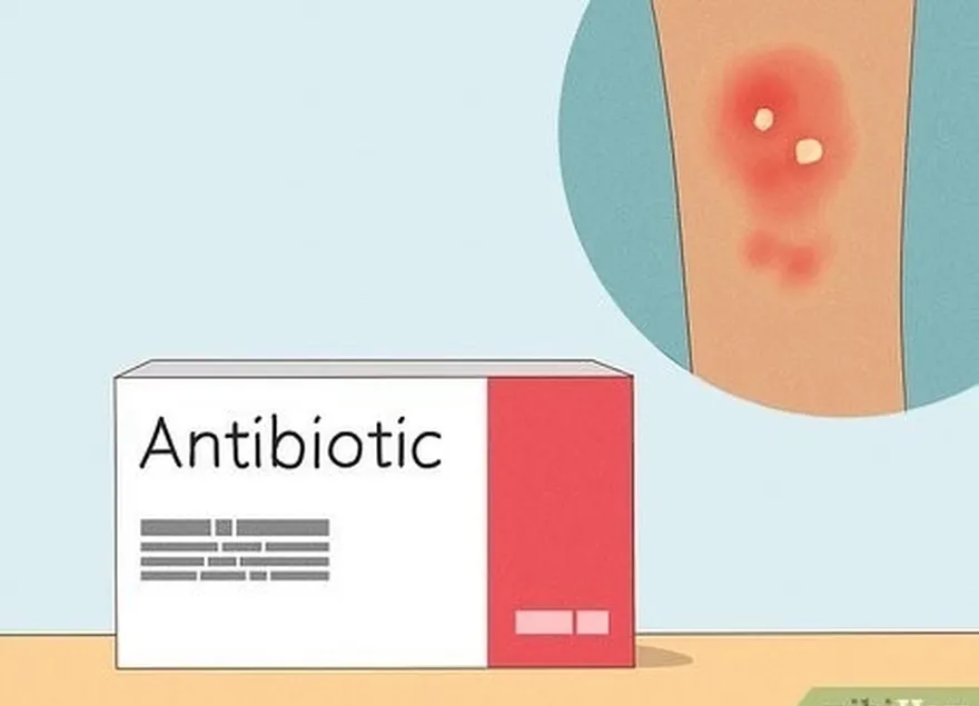 addım 3 i̇nfeksiya halında təyin edilmiş antibiotik qəbul edin.