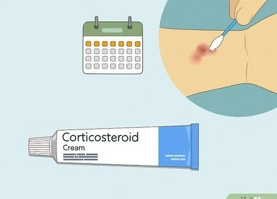 addım 1 bir həftəyə qədər reseptsiz kortikosteroid kremindən istifadə edin.