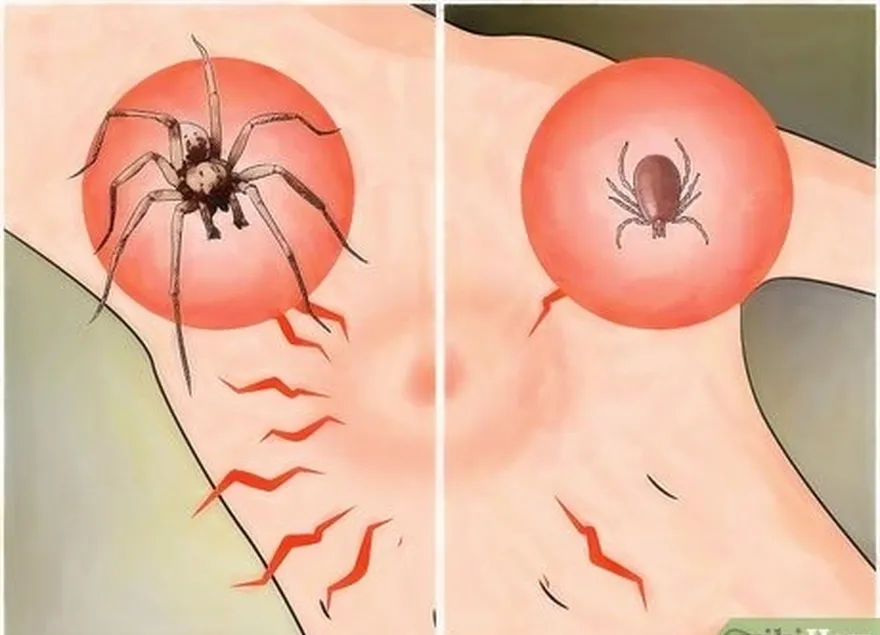 addım 3 don't confuse tick bites as spider bites.